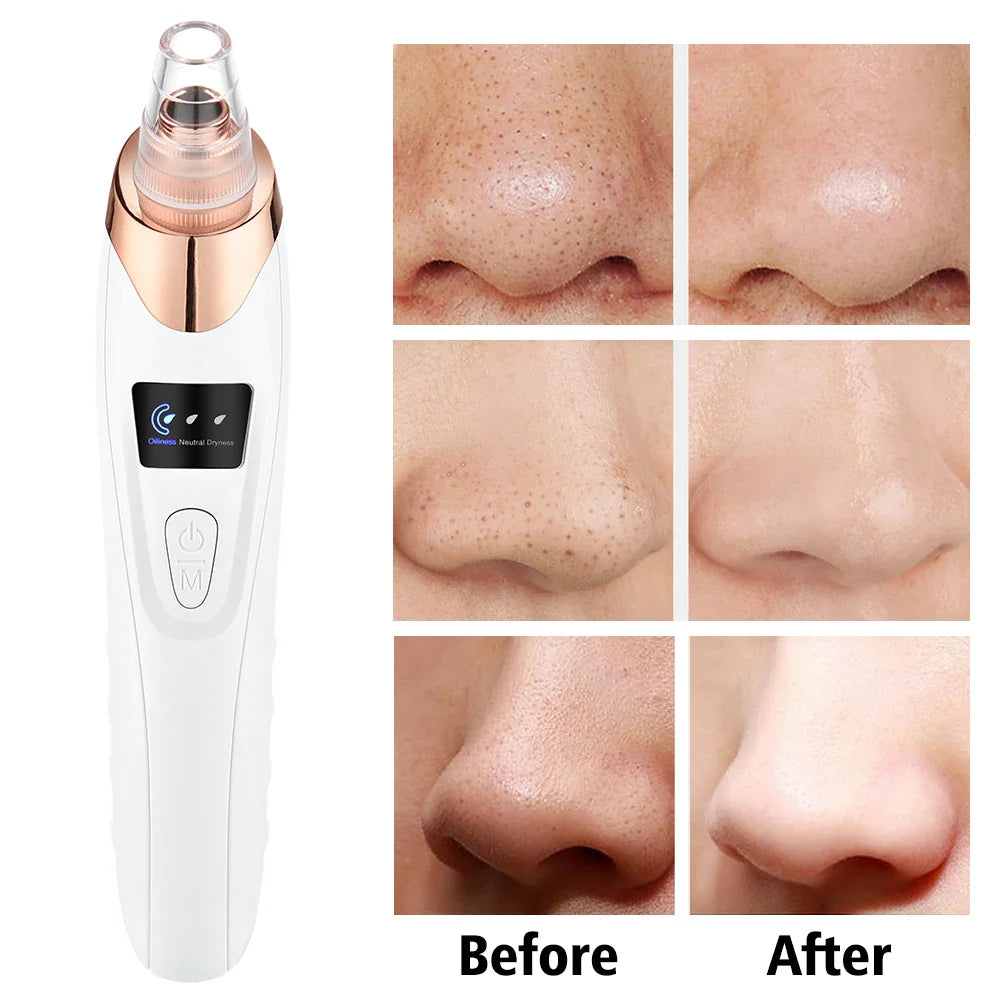 5-in-1 Acne & Blackhead Remover