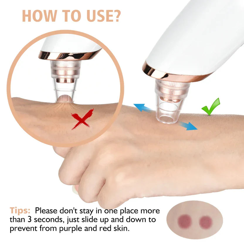 5-in-1 Acne & Blackhead Remover